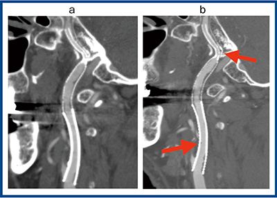 図6　右内頸動脈狭窄ステント留置症例の比較画像 a：ADCT　b：Aquilion Precision