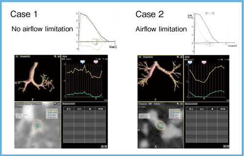 図2　4D Airway Analysisでは呼吸に伴う気管支径の狭窄（dynamic narrowing）を評価可能