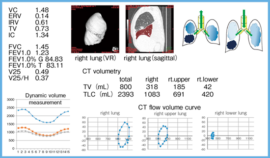 図3　全肺の呼吸動態CTによる肺の局所の評価