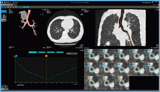 図6　全肺データを用いた気管支解析