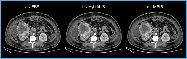 図1　腹部CT：画像再構成法による比較