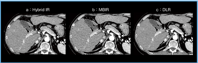 図5　腹部領域における超高精細CT