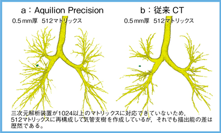 図7　症例6の気管支樹の3D画像