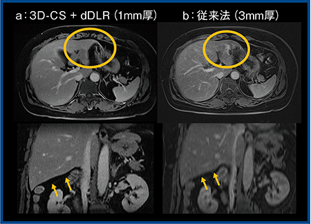 図4　腹部ダイナミックMRIにおける従来法と3D-CS＋dDLR（W.I.P.）