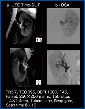図6　症例1：左腎動脈瘤コイル塞栓術後のUTE Time-SLIP（W.I.P.）
