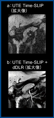 図7　症例2：上腹部のUTE Time-SLIP＋dDLR（W.I.P.）