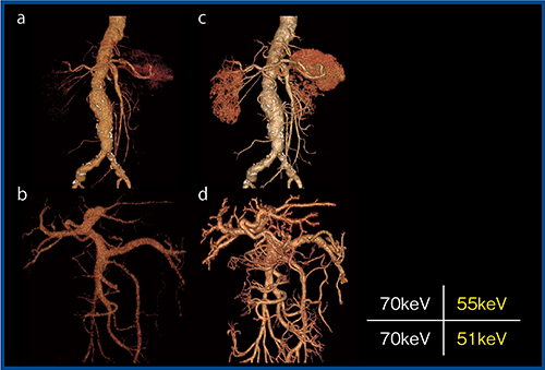 図1　低keV画像によるコントラストの向上1） 70keV（120kVp相当）画像（a，b）と比較し，低keV画像（c，d）ではコントラストが向上し，末梢血管の描出も向上している。