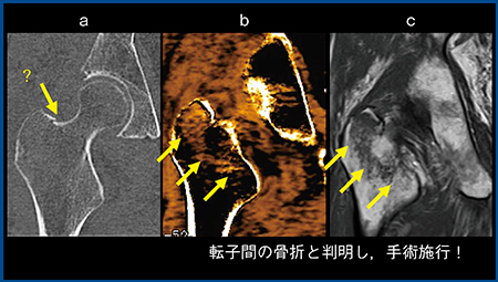 図1　症例1：大腿骨転子部骨折 a：MPR画像　b：BBI　c：T1強調画像