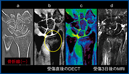 図2　症例2：橈骨遠位端骨折 a：MPR画像　b：BBI（グレイスケール画像） c：BBI（カラー画像）　d：脂肪抑制T2強調画像