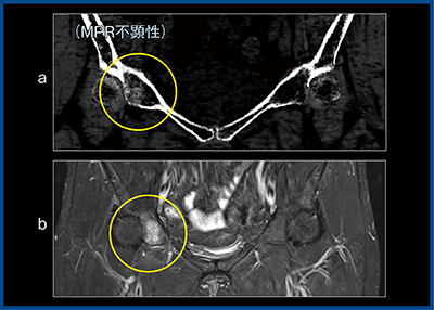 図3　症例3：股関節痛（骨挫傷） a：BBI　b：脂肪抑制T2強調画像
