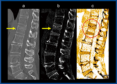 図4　症例4：腰椎椎体骨折 a：MPR画像　b：BBI（グレイスケール画像） c：BBI（カラー画像）