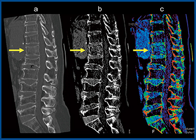 図5　症例5：腰椎椎体骨折（多椎体変形） a：MPR画像　b：BBI（グレイスケール画像） c：BBI（カラー画像） （画像提供：奥州市総合水沢病院・高橋伸光先生）