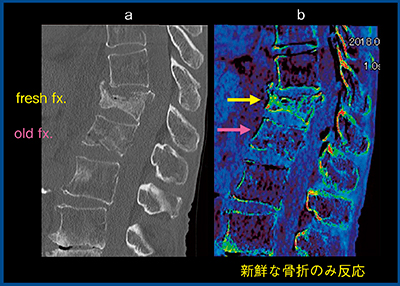 図7　症例7：腰椎椎体骨折（新鮮・陳旧比較） a：MPR画像　b：BBI