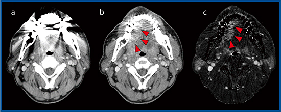 図2　症例2：右舌縁がん a：単純CT画像（SEMARなし）　b：単純CT画像（SEMARあり） c：SURESubtraction＋SEMAR
