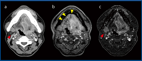 図3　症例3：舌がん a：造影CT画像　b：造影MR画像　c：SURESubtraction