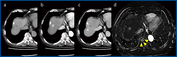 図4　症例4：肝細胞がん，骨転移 a：単純CT画像　b：造影CT画像（後期動脈相） c：造影CT画像（平衡相）　d：SURESubtraction