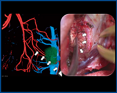 図2　症例1：術前3D-CTAと手術画像の比較