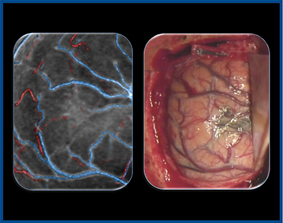 図3　症例2：右頭頂葉悪性黒色腫の術前3D-CTAと手術画像の比較