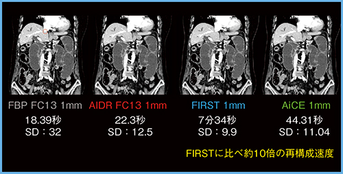 図4　腹部画像（通常線量） （撮影条件：80Helical scan，0.5s/rot，100kVp，CTDIvol 8.0mGy，DLP 445.3mGy・cm）
