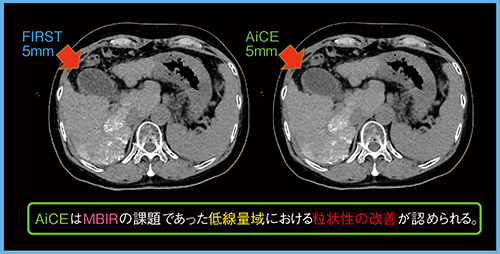 図5　腹部画像（低線量域） （撮影条件：80Helical scan，0.5s/rot，120kVp，CTDIvol 2.9mGy，DLP 86.8mGy・cm）