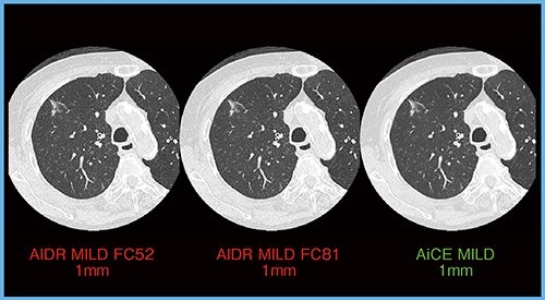 図7　肺がん（GGO） （撮影条件：80Helical scan，0.35s/rot，120kVp，CTDIvol 5.3mGy，DLP 188.7mGy・cm）