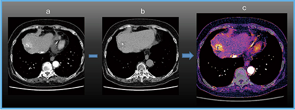 図4　造影成分を強調するCE Boost画像 a：造影CT　b：単純CT（TACE後の肝細胞がん再発）　c：CE Boost画像