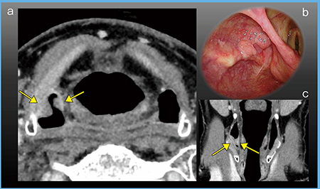 図5　症例1：下咽頭がん（T1） a：超高精細CT（1mm厚，AIDR 3D）　b：内視鏡画像 c：超高精細CT（コロナル画像，2mm厚）