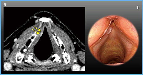 図6　症例2：声門がん（T1a） a：超高精細CT（1mm厚，AIDR 3D）　b：内視鏡画像