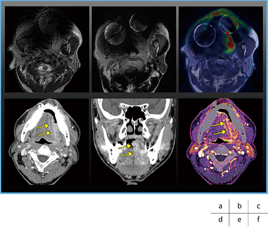 図7　症例3：左舌縁がん（T3） a：MRI（T2WI）　b：MRI（T2WI＋Gd）　c：PET/MRI d，e：超高精細CT（SEMAR）　f：CE Boost画像