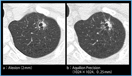 図4　症例4：肺腺癌（part solid nodule）