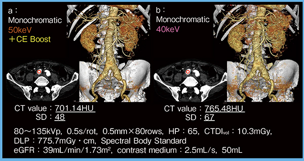 図3　症例1：50keV Mono画像＋CE Boostによる造影増強効果（総腸骨動脈瘤）