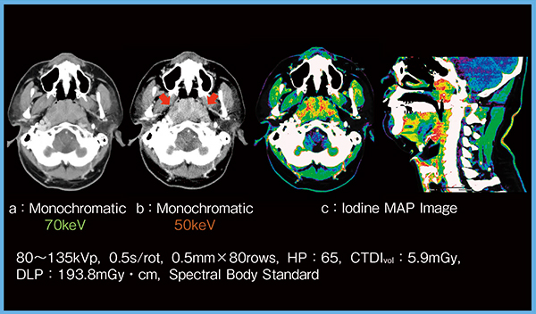 図5　症例3：50keV Mono画像＋ヨードマップによる腫瘍の視認性の向上（上咽頭がん）