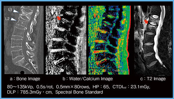 図6　症例4：Water/Calcium Imageによる髄内新生出血の確認（腰椎圧迫骨折）
