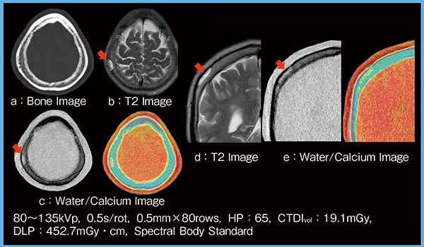 図7　症例5：Water/Calcium Imageによる腫瘍の広がりの評価（頭蓋骨海綿状血管腫）