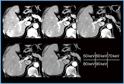 図2　症例2：原発性肝細胞がん（70歳代，男性）の各エネルギーレベルの仮想単色X線画像