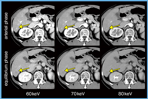 図3　症例3：原発性肝細胞がん（70歳代，女性）の仮想単色X線画像