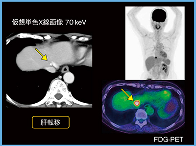 図4　症例4：直腸がん術後（60歳代，女性）の肝転移の検出