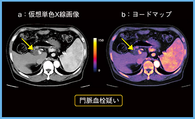 図5　症例5：肝腫瘍疑い（60歳代，男性）の仮想単色X線画像（a）とヨードマップ（b）