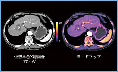 図6　症例6：原発性肝細胞がんRFA後（70歳代，男性）