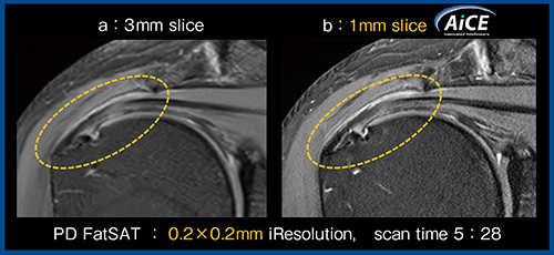 図2　脂肪抑制PD強調画像へのAiCEの適用（棘上筋腱関節面側の部分断裂）