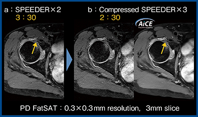 図4　Compressed SPEEDERとAiCEの併用による脂肪抑制PD強調画像（関節唇損傷）