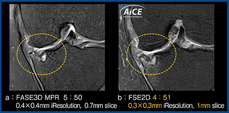 図5　AiCE適用の2D thin slice画像による脛骨骨壊死と大腿骨・脛骨の軟骨欠損の評価