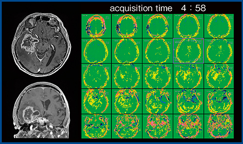 図4　FFEEPI3Dによる全脳の画像（図3と同一症例）