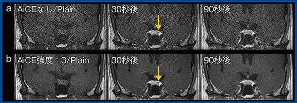 図2　下垂体ダイナミックスタディへのAiCEの応用（下垂体微小腺腫） a：AiCEなし　b：AiCEあり