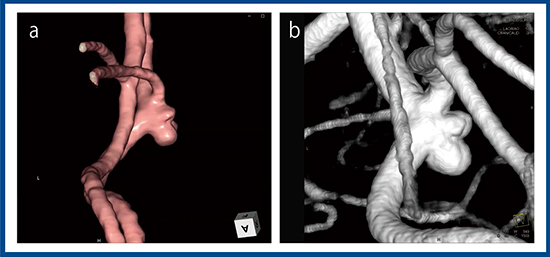 図1　症例1：前大脳動脈末梢の未破裂脳動脈瘤 a：3D-CTA　b：血管撮影3D画像