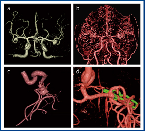 図2　症例2：中大脳動脈の未破裂脳動脈瘤 a：3D-MRA　b：3D-CTA　c：3D-CTA（拡大） d：3D-CTA（術後フォローアップ）