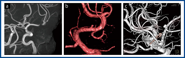 図3　症例1の別の動脈瘤の術後フォローアップ a：MRA　b：3D-CTA　c：血管撮影3D画像