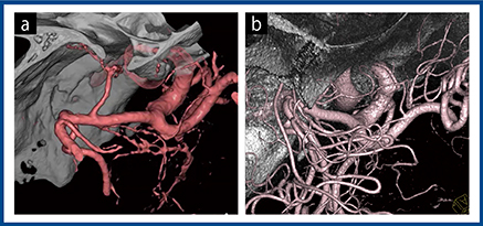 図4　症例3：左内頸動脈–後交通動脈の未破裂脳動脈瘤 a：3D-CTA　b：血管撮影3D画像