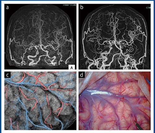 図7　症例6：右中大脳動脈閉塞症 a：従来のCTのCTA　b：Aquilion PrecisionのCTA c：Aquilion PrecisionのVR画像で描出した脳表の動静脈 d：実際の手術で観察された脳表の動静脈