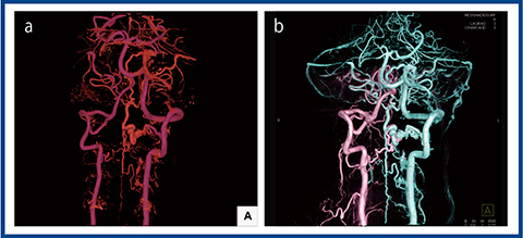 図8　症例7：頭蓋頸椎移行部の硬膜動静脈瘻 a：3D-CTA　b：血管撮影3D画像